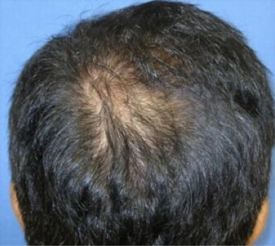 Alopecia After 7 Treatments